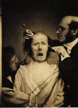 Figure 3 : à dr., le docteur Guillaume Duchenne (1806-1875), précurseur de la neurologie. Il déclenche chez son patient une expression de frayeur par la stimulation électrique (image Wikipedia).