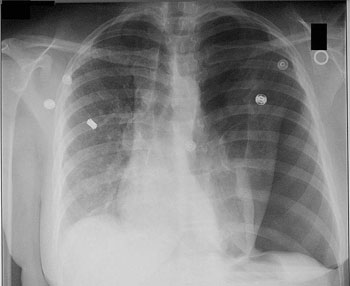 Figure 3 : Image par radiographie d’un pneumothorax (en bas à droite) (image WikiCommons, auteur Medical Cases)