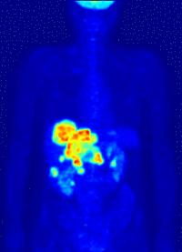 Figure 3 : Tomographie par émission de positons. Un élément radioactif artificiel, le Fluor 18 (un neutron de moins que le Fluor 19 classique) est incorporé à une solution de glucose. Les cellules cancéreuses, à forte activité, ont besoin d’énergie sous forme de glucose et fixent la solution. Les positons émis par radioactivité ϐ+ par le fluor vont s’annihiler avec des électrons et émettre des photons γ, visibles sur le cliché, et permettant de localiser les cellules cancéreuses.