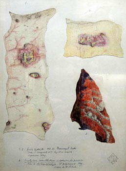 Figure 1 : Une planche d’album de 1849 réalisée à l’encre aquarelle et au crayon et représentant un « emphysème inter-lobulaire ou collapsus du poumon » ©Musée de l’AP-HP/ Photo : HCS